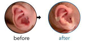 Before-and-after EarBuddies Folded-Over Helical Rim result; started at 1–3 months – Jenna