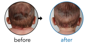 Before-and-after EarBuddies Stick-Out Ears result; started at 1–3 months – Mrs. D & her Daughter