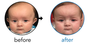 Before-and-after EarBuddies Stick-Out Ears result; started at 3–6 months – Paige & her Son Noah