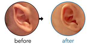 Before-and-after EarBuddies Folded-Over Helical Rim result; started at 1–3 months – Kelly & her Son Maverick