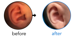 Before-and-after EarBuddies Conchal Crus result; started at 1–3 months – Marlena & her Son