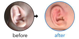 Before-and-after EarBuddies Stahl's Bar result; started at 1–3 months – Amy & her Daughter Everly