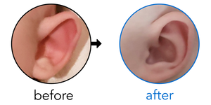 Before-and-after EarBuddies Stick-Out Ears result; started within the first month – Nicole & her Daughter