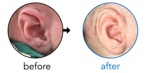 Before-and-after EarBuddies Stahl's Bar result; started within the first month – Toni & her Son Logan
