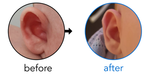 Before-and-after EarBuddies Stick-Out Ears result; started within the first month – Joni & her Son Fletcher
