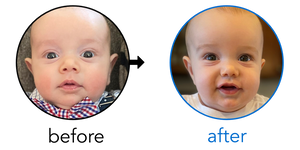 Before-and-after EarBuddies Stick-Out Ears result; started at 3–6 months – Siobhan & her Son Logan