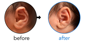Before-and-after EarBuddies Rim Kink result; started within the first month – Luise & her son Zachary