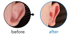 Before-and-after EarBuddies Stick-Out Ears result; started at 1–3 months – Jessica A