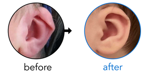 Before-and-after EarBuddies Lop Ear result; started at 3–6 months – Mrs. P