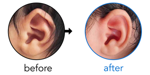 Before-and-after EarBuddies Folded-Over Helical Rim result; started within the first month – Teresa & her Son