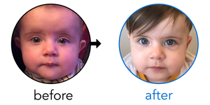 Before-and-after EarBuddies Stick-Out Ears result; started at 6–12 months – Jennifer, Luke & their Daughter Eloise