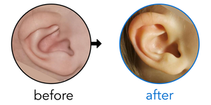 Before-and-after EarBuddies Lop Ear result; started at 3–6 months – Mrs L & her Daughter