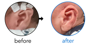 Before-and-after EarBuddies Stahl's Bar result; started within the first month – Kathleen & her son