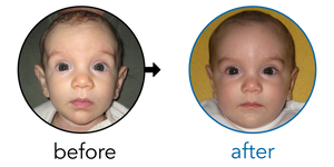 Before-and-after EarBuddies Stick-Out Ears result; started at 1–3 months – Alžběta & her children Lucie and Arthur