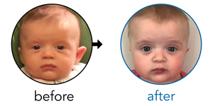 Before-and-after EarBuddies Stick-Out Ears result; started at 3–6 months – Lindsay & her Son Jasper