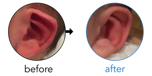 Before-and-after EarBuddies Lop Ear result; started within the first month – Dev & her Son