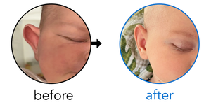 Before-and-after EarBuddies Stick-Out Ears result; started within the first month – Genevieve, Chris, & baby Clay