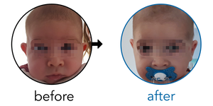 Before-and-after EarBuddies Stick-Out Ears result; started at 1–3 months – Andrea & her Son