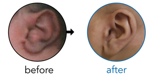 Before-and-after EarBuddies Conchal Crus result; started within the first month – Mrs N. & her Son