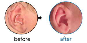 Before-and-after EarBuddies Rim Kink result; started within the first month – Mr. O, NHS Doctor