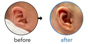 Before-and-after EarBuddies Conchal Crus result; started within the first month – Olivia & her daughter Isadora