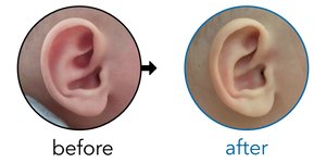 Before-and-after EarBuddies Conchal Crus result; started at 3–6 months – Diana & her daughter Dara