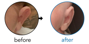 Before-and-after EarBuddies Stick-Out Ears result; started within the first month – Sam & his son