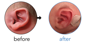 Before-and-after EarBuddies Stick-Out Ears result; started within the first month – Katherine & her Daughter Penelope