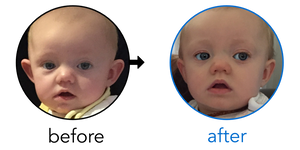 Before-and-after EarBuddies Stick-Out Ears result; started at 3–6 months – Tara & her Daughter Charlie
