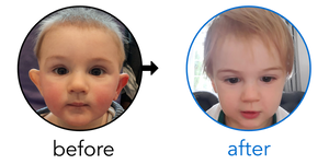 Before-and-after EarBuddies Stick-Out Ears result; started at 6–12 months – Danielle & her Son Jack