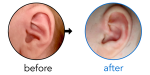Before-and-after EarBuddies Conchal Crus result; started at 1–3 months – Carrie & her daughter Joanna