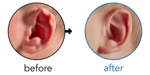 Before-and-after EarBuddies Rim Kink result; started within the first month – Rebecca & her son Rafferty