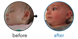 Before-and-after EarBuddies Stick-Out Ears result; started at 1–3 months – Niki & her Daughter Emilia