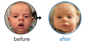 Before-and-after EarBuddies Stick-Out Ears result; started within the first month – Courtney & her daughter Macy