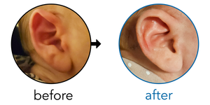 Before-and-after EarBuddies Folded-Over Helical Rim result; started at 1–3 months – Meira & her daughter