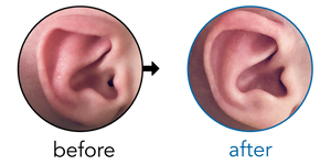 Before-and-after EarBuddies Lop Ear result; started within the first month – Chris, Melody & their baby Son