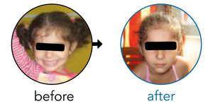 Before-and-after EarBuddies Stick-Out Ears result; started at 18+ months – Mrs T & her Daughter