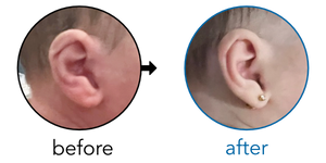 Before-and-after EarBuddies Lop Ear result; started within the first month – Shoshana & her daughter Ilona