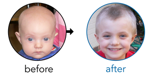 Before-and-after EarBuddies Stick-Out Ears result; started at 1–3 months – Kay R. & her Son Jason