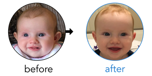 Before-and-after EarBuddies Stick-Out Ears result; started at 3–6 months – Emma, Peter & their Daughter Sophie