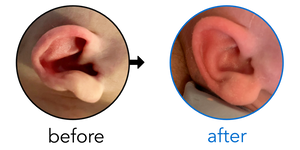 Before-and-after EarBuddies Stick-Out Ears result; started within the first month – Chloe & her daughter Holly
