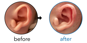Before-and-after EarBuddies Stick-Out Lobe result; started at 3–6 months – Danielle & her daughter Kadie