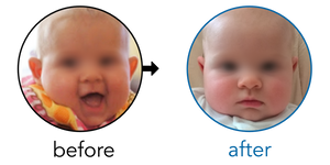 Before-and-after EarBuddies Stick-Out Ears result; started at 3–6 months – Mrs J & her Daughter