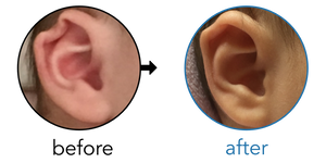 Before-and-after EarBuddies Rim Kink result; started at 3–6 months – Mrs. M & her Daughter