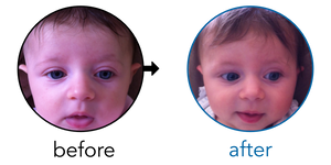 Before-and-after EarBuddies Stick-Out Ears result; started at 1–3 months – Genna & her Daughter