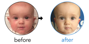 Before-and-after EarBuddies Stick-Out Ears result; started at 3–6 months – Lola, Stelios & their Daughter Alejandra