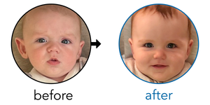 Before-and-after EarBuddies Stick-Out Ears result; started at 3–6 months – Anna & her son Tommy