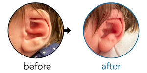 Before-and-after EarBuddies Conchal Crus result; started within the first month – Kerry & her son