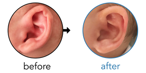 Before-and-after EarBuddies Rim Kink result; started at 1–3 months – Amelia & her Son Carter