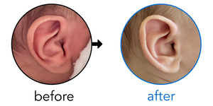 Before-and-after EarBuddies Conchal Crus result; started within the first month – Molly, Tyler & their Son Killian